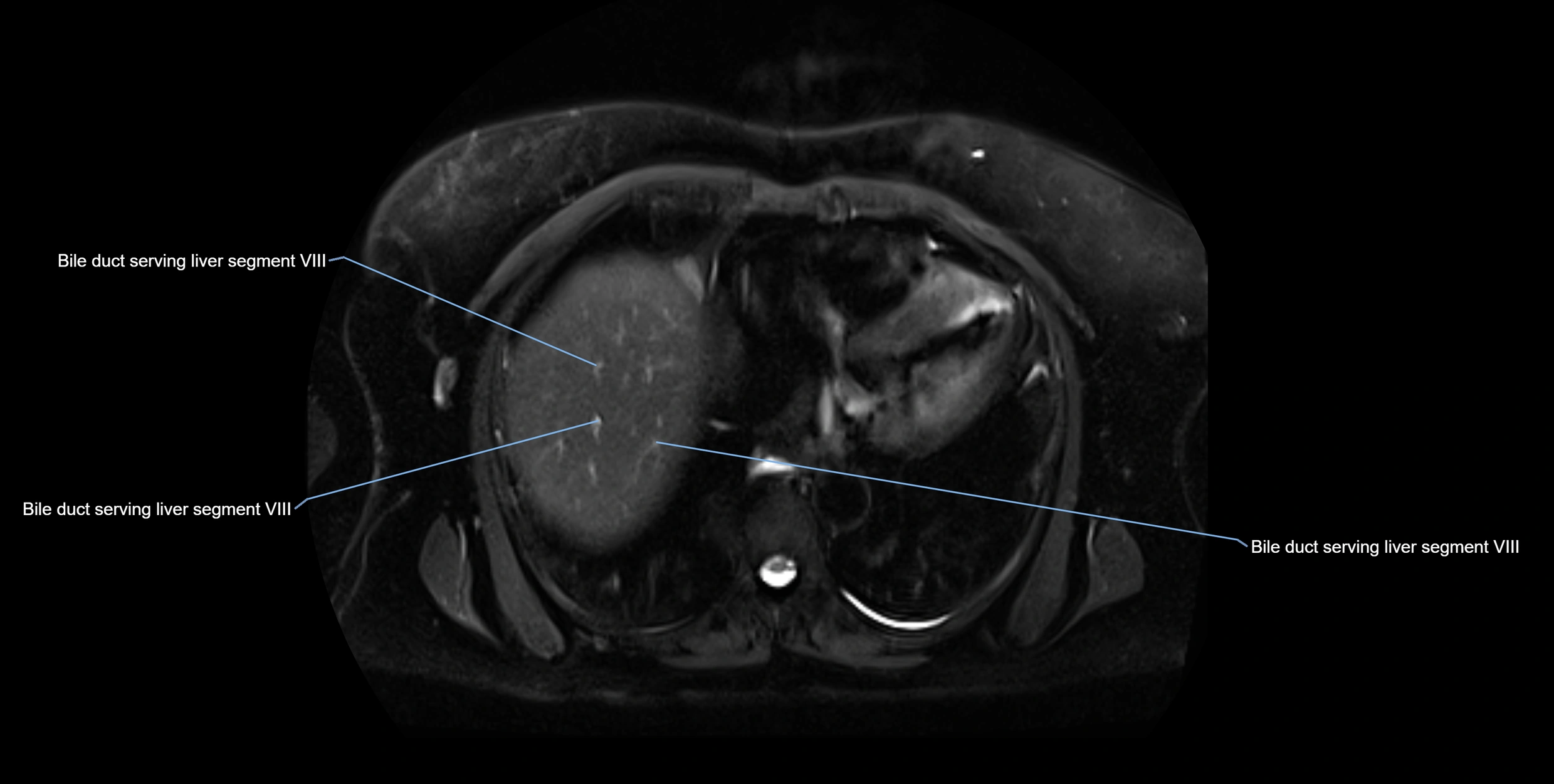 MRI MRCP axial cross sectional anatomy 3T radiology  image-img-10001-00005.webp
